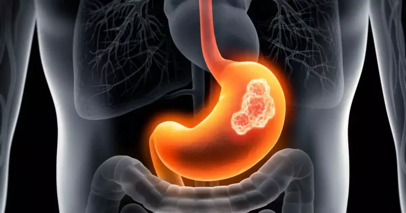 Is It Just Acidity or Stomach Cancer? 6 Warning Signs That Demand Immediate Medical Attention