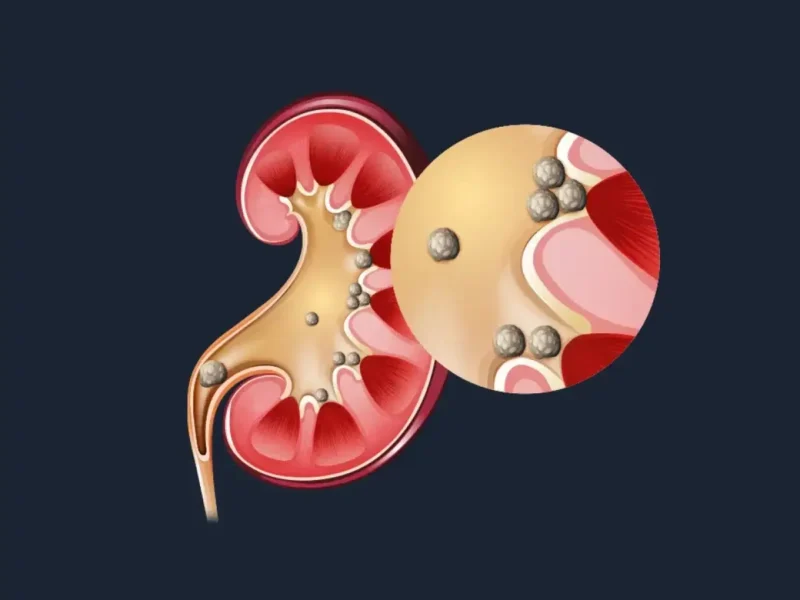 The Agony of Kidney Stones: Causes, Prevention, and Doctor's Advice